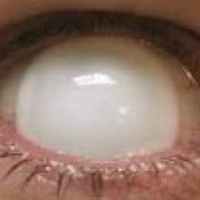 【ミニ全眼】ホワイト (ブラインド)【視界減少】 (17mm)- SFX-EYES 全眼カラコン 特殊カラコン コスプレ ハロウイン オーダーメイド アニメ 漫画 度付き 度入り 度あり